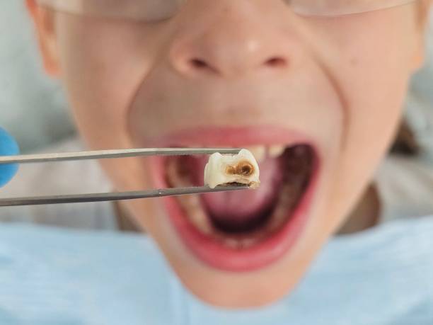 Best Same-Day Emergency Dental Services in Jones Creek, TX